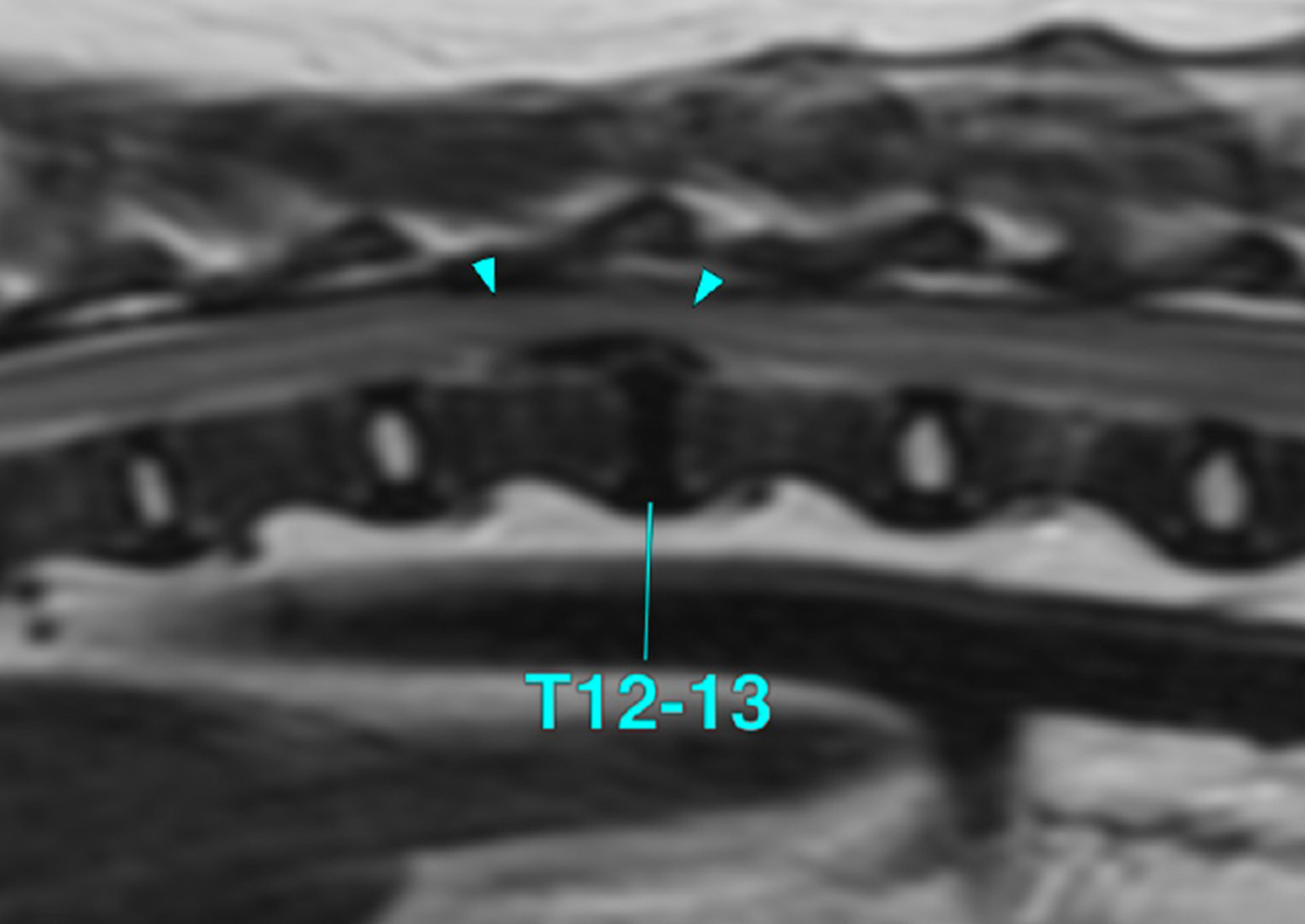 椎間板ヘルニア（グレードV）に対する外科治療