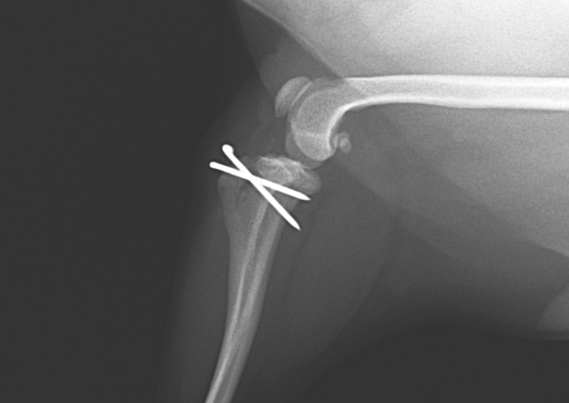 膝蓋骨脱臼の外科治療